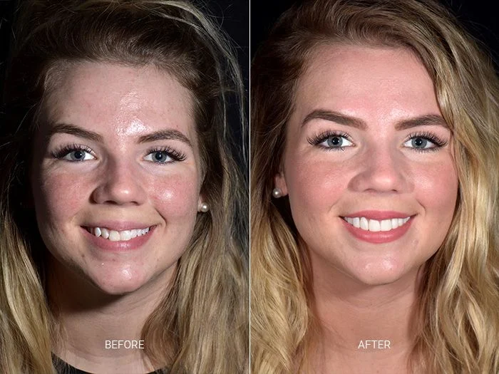 E.Max Porcelain Veneers