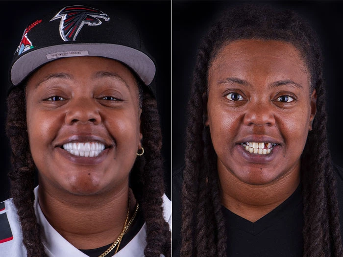Smile Makeover