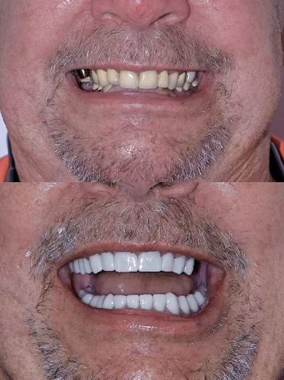 Before and after close-up of a white male patient showing missing molars and discolored lower front teeth, followed by a full, bright smile after receiving a denture with dental implants in Cancun.