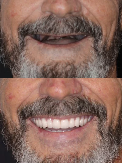 Before and after photos of a man in his 50s–60s with no natural teeth, later smiling confidently with a full denture anchored by dental implants in Cancun, showing a natural-looking result.