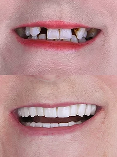 Close-up of an older man’s mouth showing decayed, discolored, and broken teeth before treatment, followed by a restored, healthy smile with a custom denture placed over dental implants in Mexico.