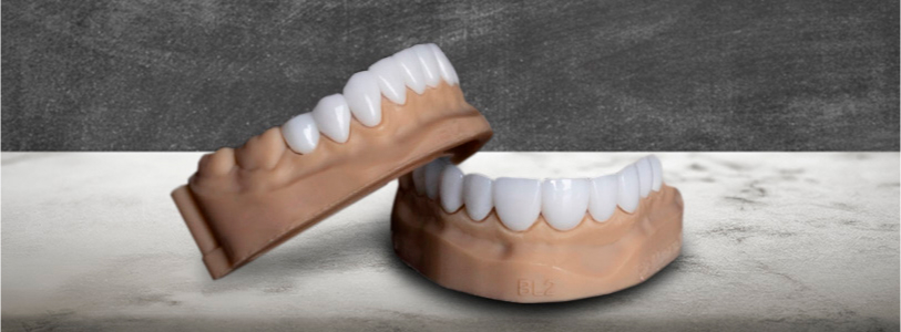 dental lumeneers teeth
