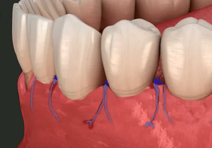 A 3D dental illustration showing a pedicle graft procedure, where adjacent gum tissue is loosened and sutured over exposed tooth roots to repair gum recession.
